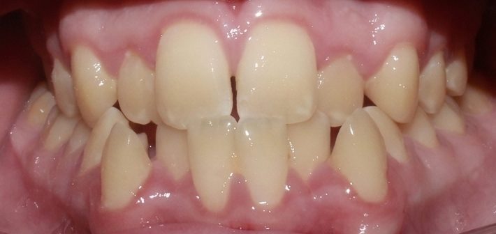 Vivid Smiles patient case 9 before and after treatment comparison before